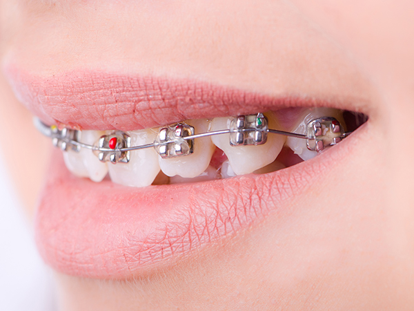 투명교정,브라켓교정 치아교정