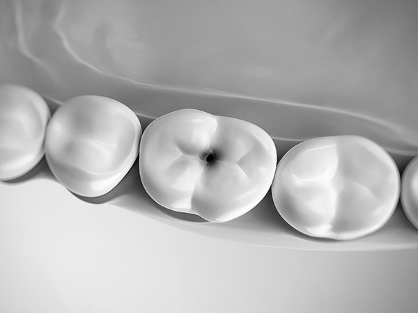 충치치료 자연치아살리기