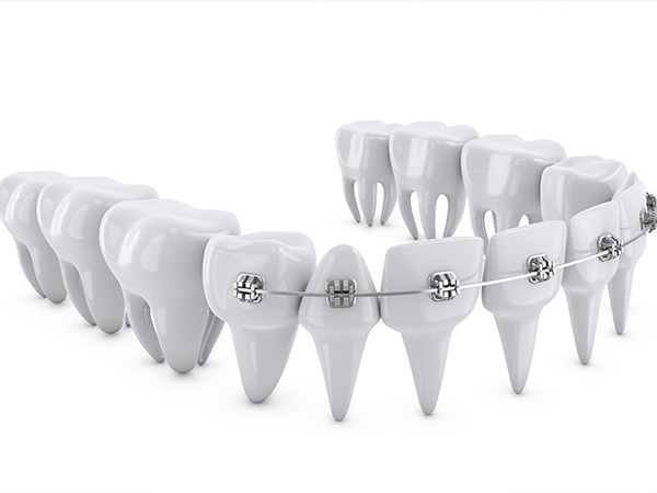 투명교정,브라켓교정 치아교정