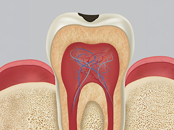 충치치료 자연치아살리기