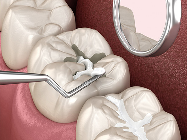 맞춤형 도포마취