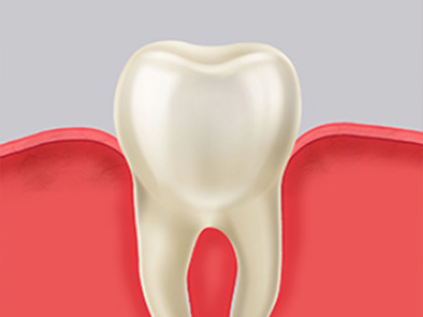 잇몸치료 자연치아살리기