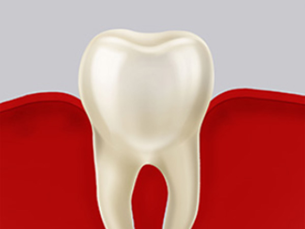 잇몸치료 자연치아살리기