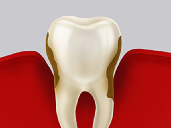잇몸치료 자연치아살리기