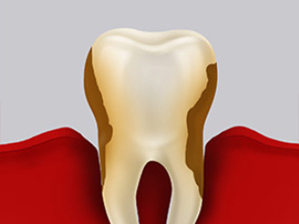 잇몸치료 자연치아살리기