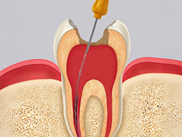 신경치료 자연치아살리기
