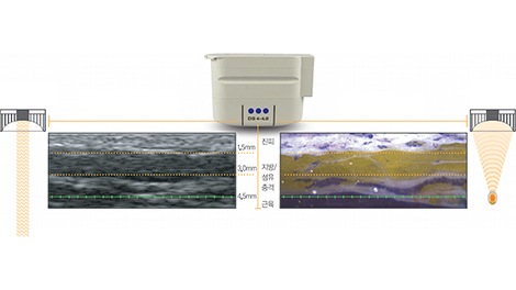 라미네이트 심미치료