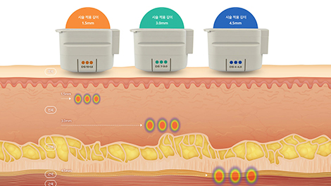 라미네이트 심미치료