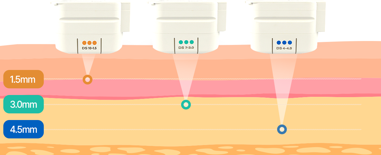 점,사마귀,티눈 레이저