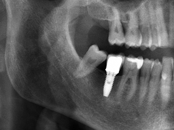 최소식립 전악임플란트 임플란트