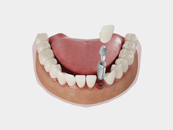 무절개 임플란트틀니 임플란트