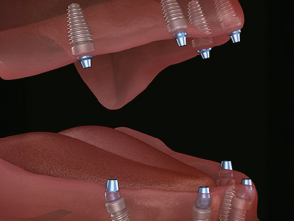 무절개 임플란트틀니 임플란트