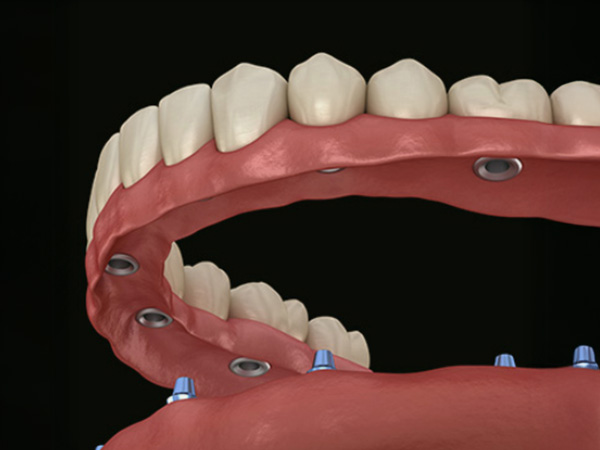 무절개 임플란트틀니 임플란트