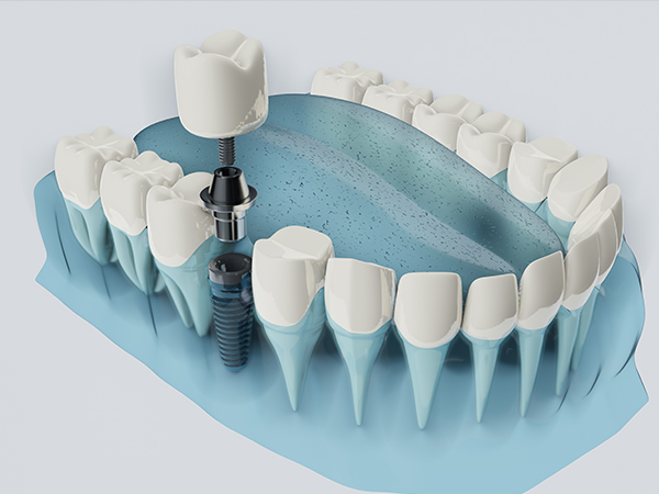임플란트 살리기와 재수술 임플란트