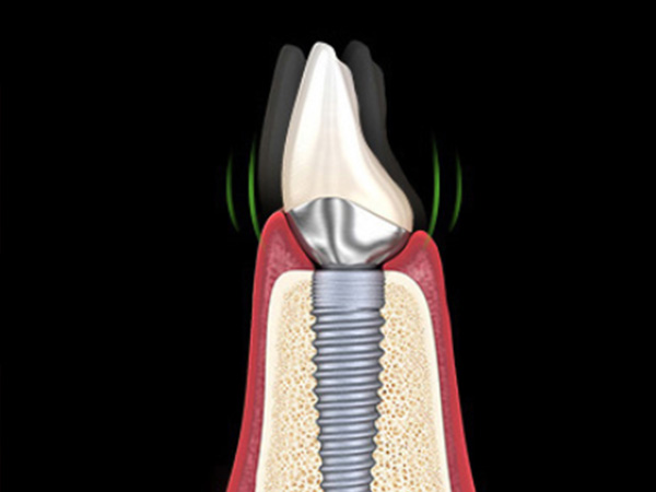 임플란트 살리기와 재수술 임플란트